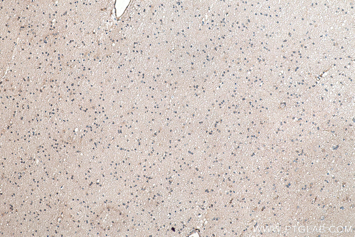 Immunohistochemical analysis of paraffin-embedded human gliomas tissue slide using KHC0359 (MYO16 IHC Kit).