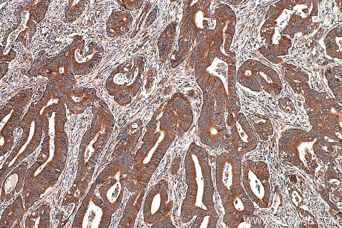 Immunohistochemical analysis of paraffin-embedded human colon cancer tissue slide using KHC0366 (MYO1A IHC Kit).