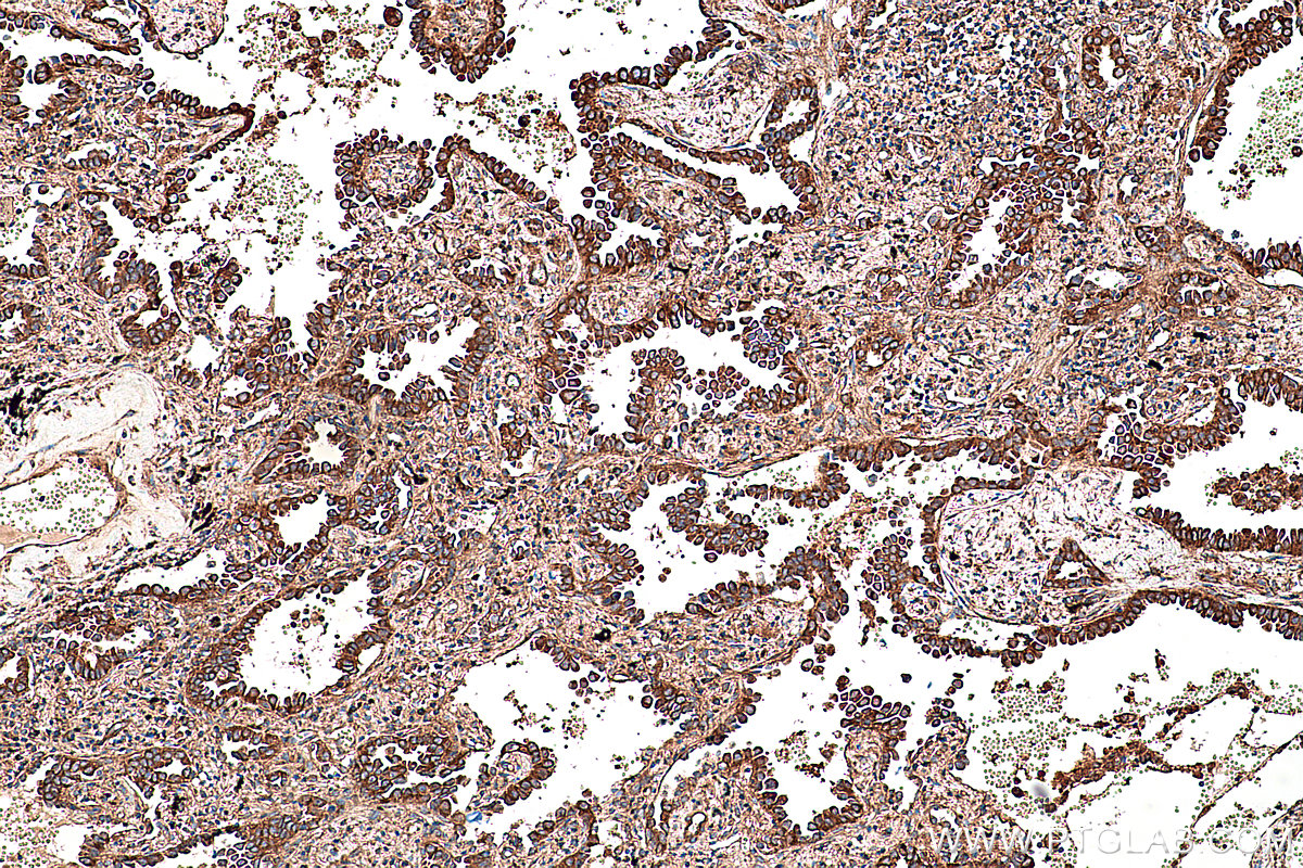 Immunohistochemical analysis of paraffin-embedded human lung cancer tissue slide using KHC0366 (MYO1A IHC Kit).