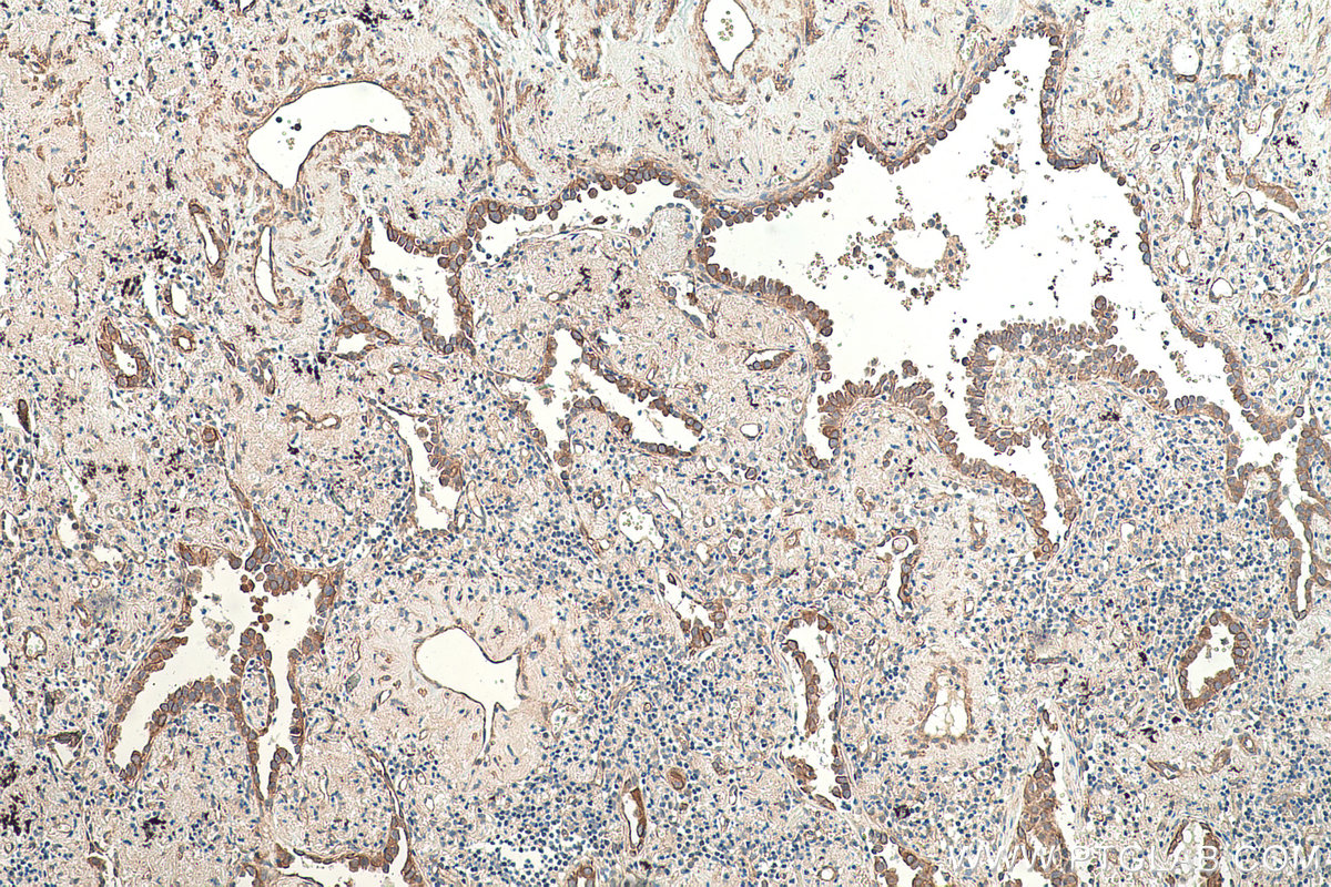 Immunohistochemical analysis of paraffin-embedded human lung cancer tissue slide using KHC0353 (MYO1C IHC Kit).