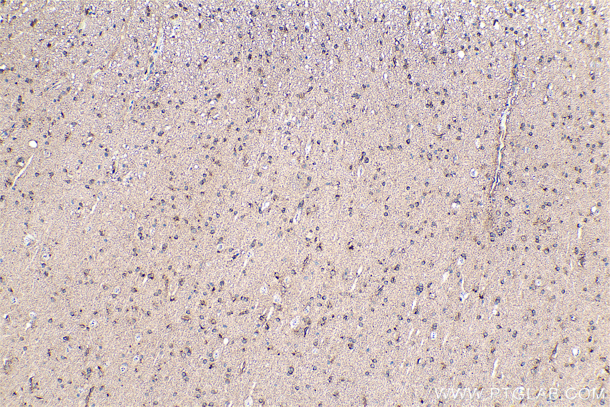 Immunohistochemical analysis of paraffin-embedded human gliomas tissue slide using KHC0357 (MYO6 IHC Kit).