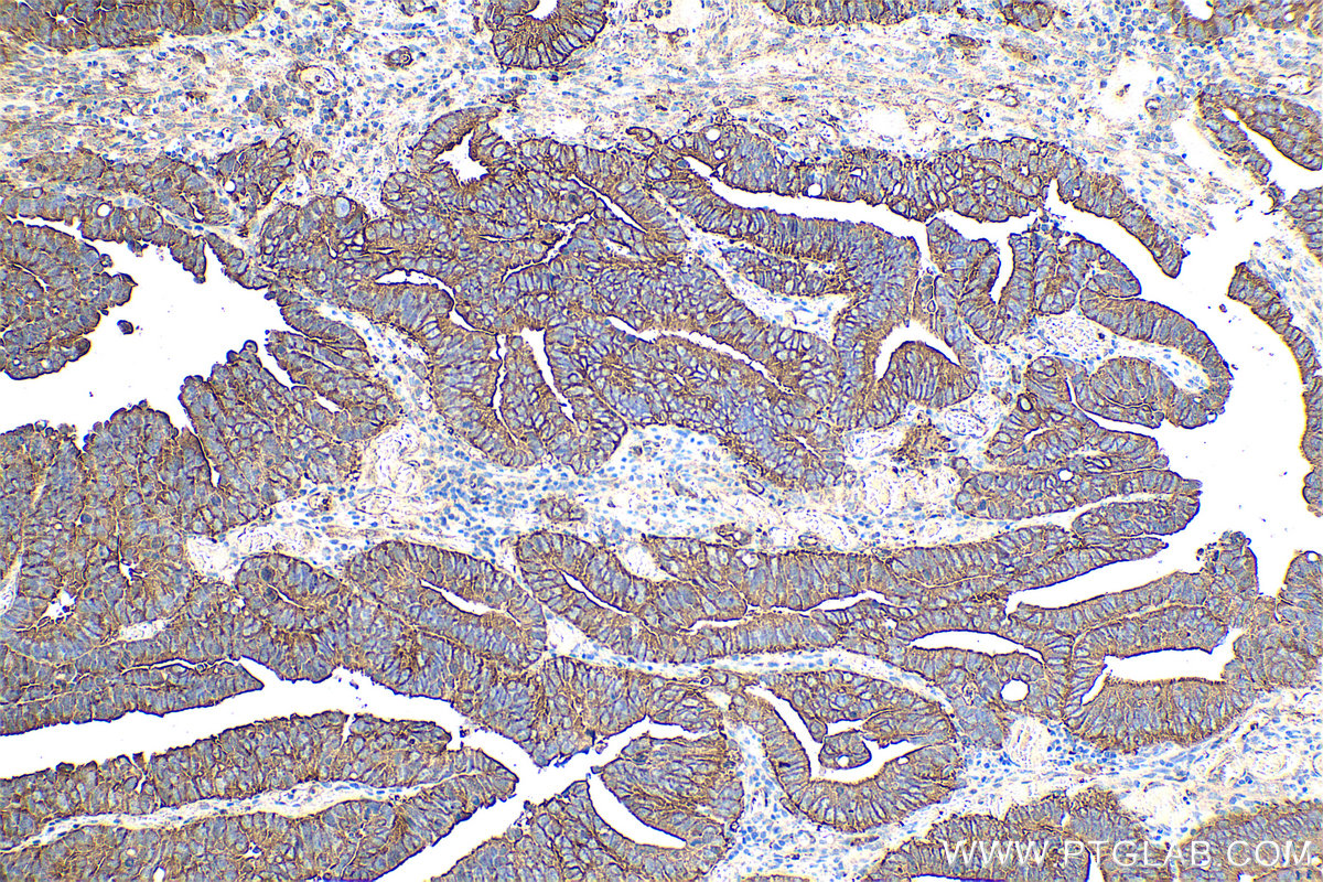 Immunohistochemical analysis of paraffin-embedded human colon cancer tissue slide using KHC0357 (MYO6 IHC Kit).