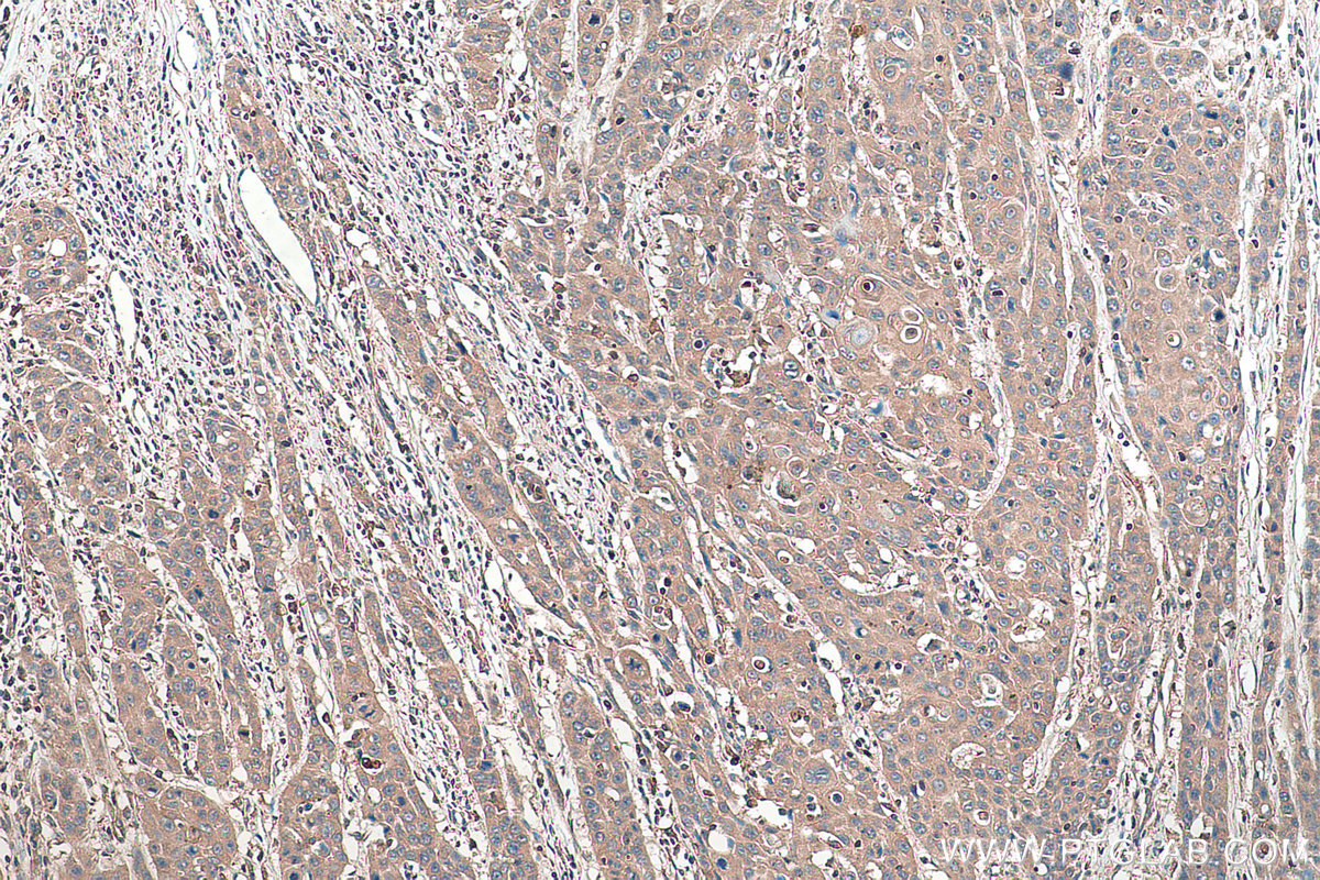 Immunohistochemical analysis of paraffin-embedded human oesophagus cancer tissue slide using KHC0371 (MYO9B IHC Kit).