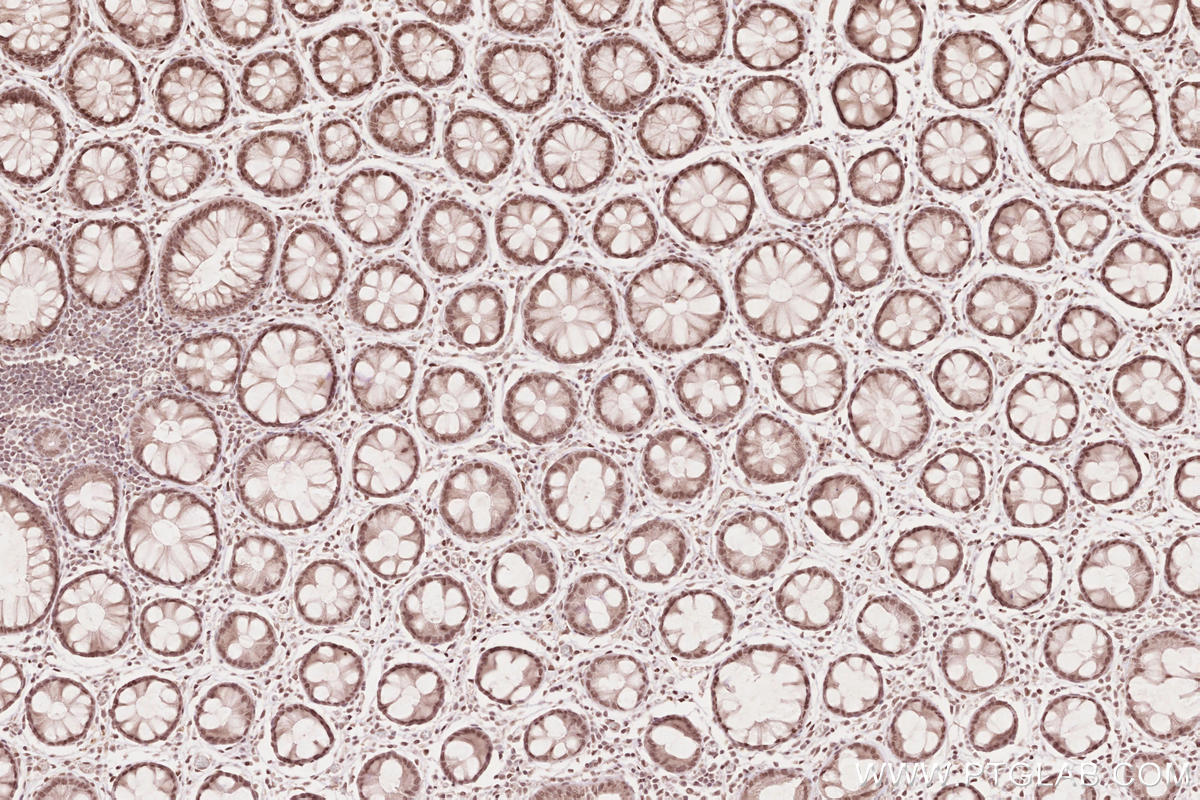 Immunohistochemical analysis of paraffin-embedded human rectal cancer tissue slide using KHC2632 (MYPN IHC Kit).