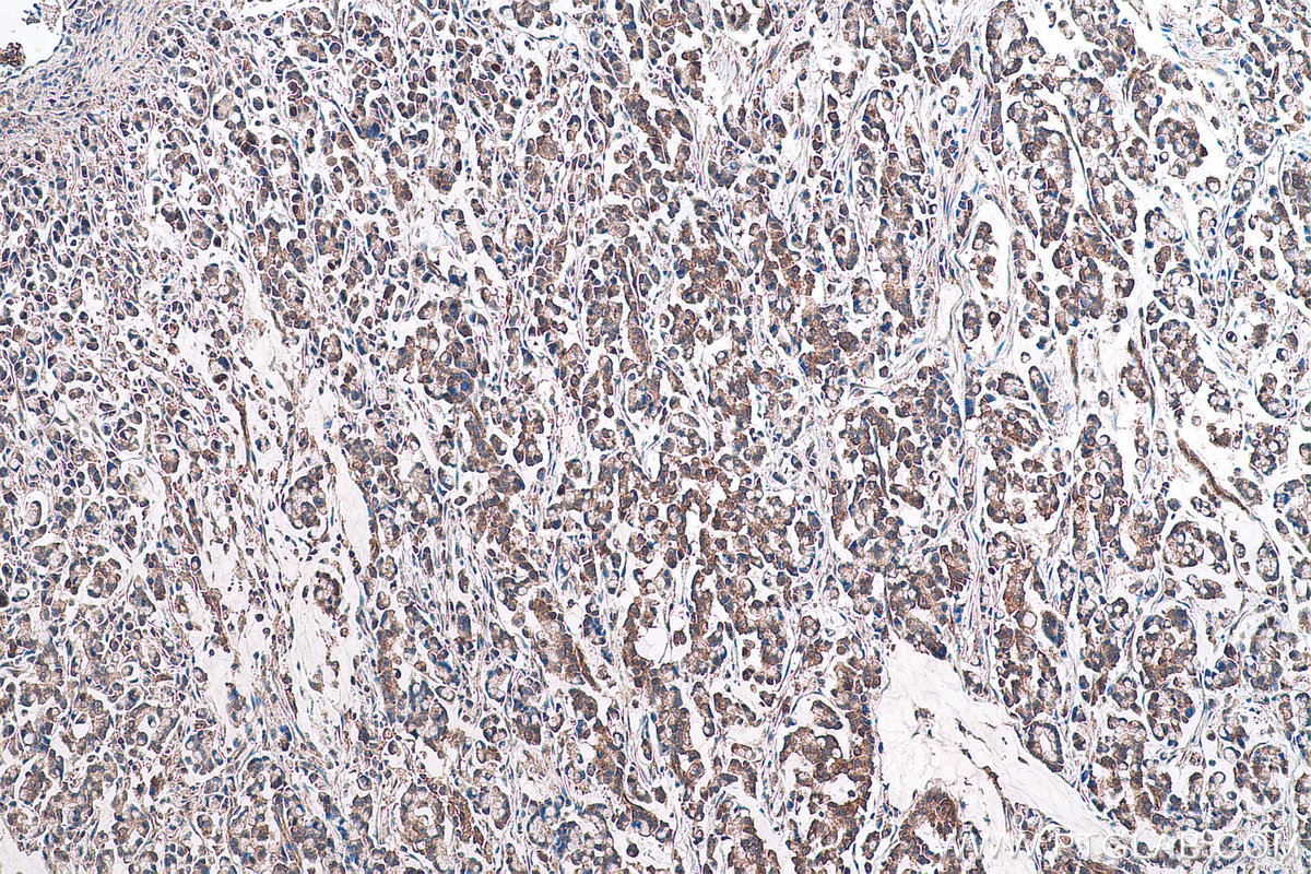 Immunohistochemical analysis of paraffin-embedded human colon cancer tissue slide using KHC0950 (NAA10/ARD1A IHC Kit).