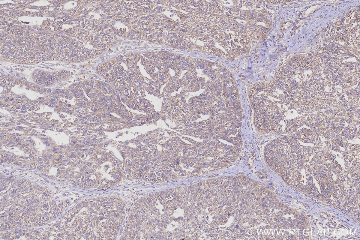 Immunohistochemical analysis of paraffin-embedded human ovary cancer tissue slide using KHC3098 (NACA IHC Kit).