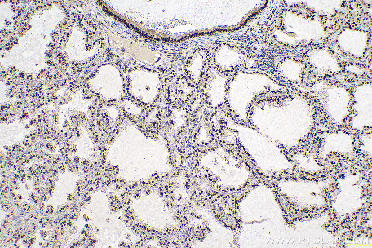 Immunohistochemical analysis of paraffin-embedded human lung cancer tissue slide using KHC0681 (NANS IHC Kit).