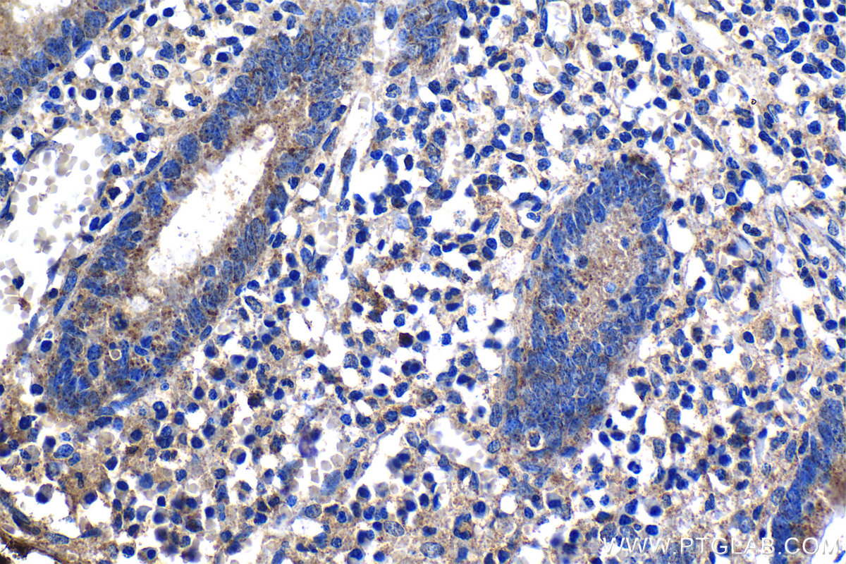 Immunohistochemical analysis of paraffin-embedded human appendicitis tissue slide using KHC1298 (NARS2 IHC Kit).