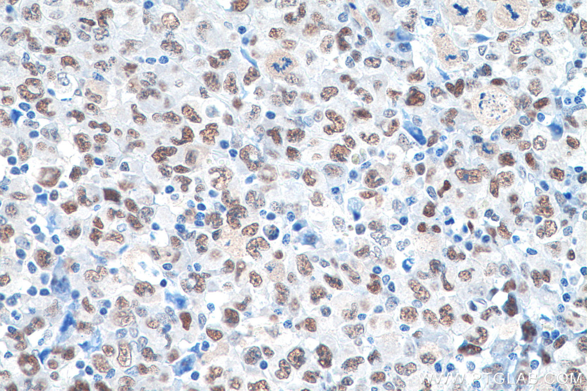 Immunohistochemical analysis of paraffin-embedded human lymphoma tissue slide using KHC0842 (NASP IHC Kit).