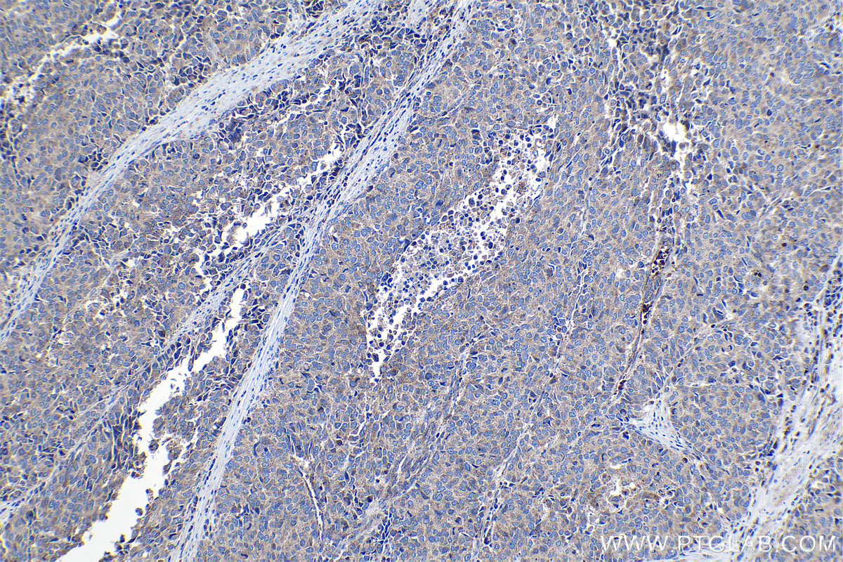 Immunohistochemical analysis of paraffin-embedded human stomach cancer tissue slide using KHC1140 (NCKAP1L IHC Kit).