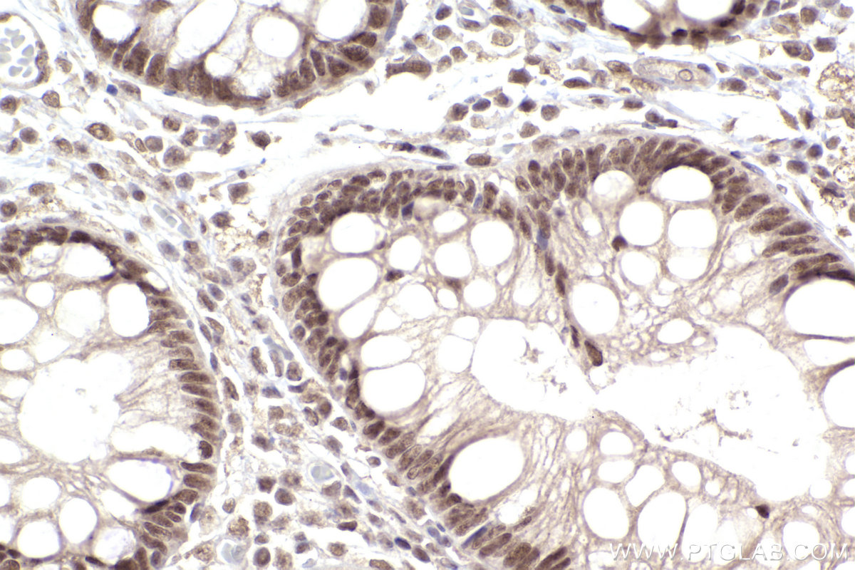 Immunohistochemical analysis of paraffin-embedded human rectal cancer tissue slide using KHC2492 (NCOA2 IHC Kit).