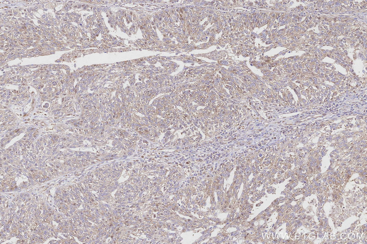 Immunohistochemical analysis of paraffin-embedded human ovary cancer tissue slide using KHC3164 (ND4 IHC Kit).