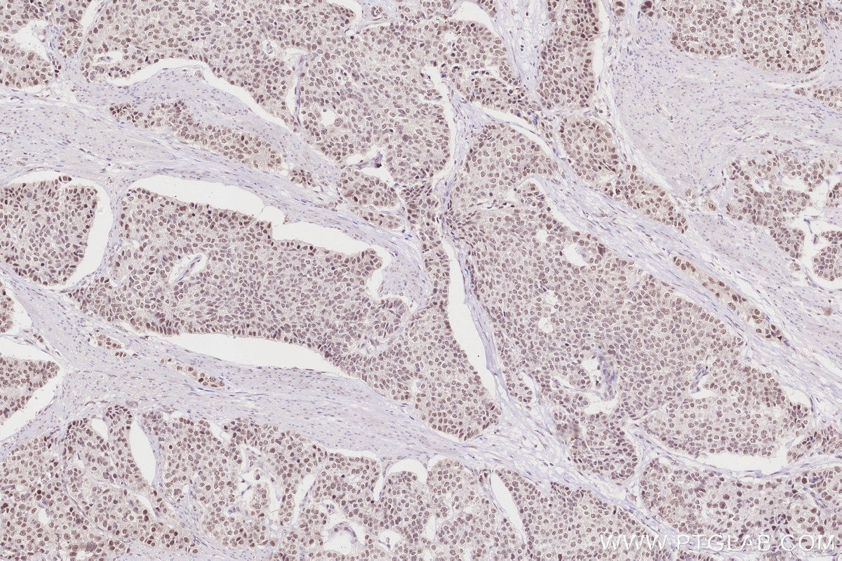 Immunohistochemical analysis of paraffin-embedded human stomach cancer tissue slide using KHC2836 (NDNL2 IHC Kit).
