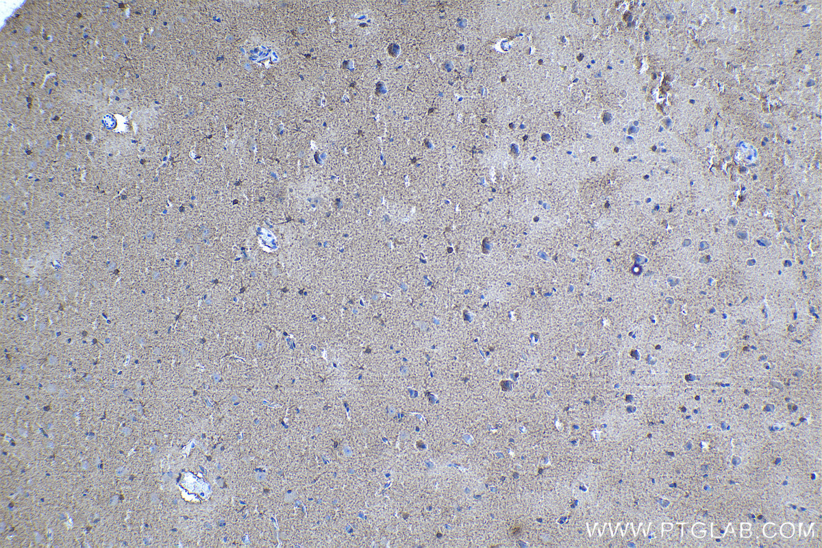 Immunohistochemical analysis of paraffin-embedded human gliomas tissue slide using KHC1010 (NDRG2 IHC Kit).