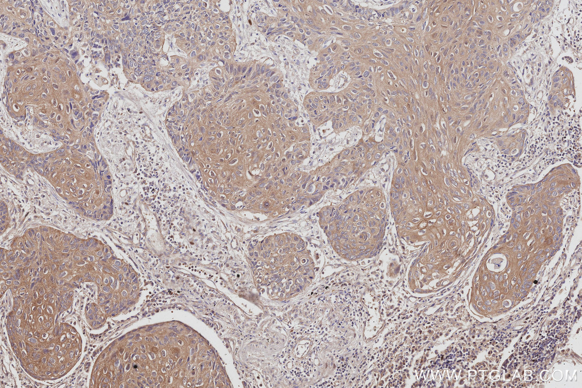 Immunohistochemical analysis of paraffin-embedded human lung cancer tissue slide using KHC3037 (NDRG4 IHC Kit).