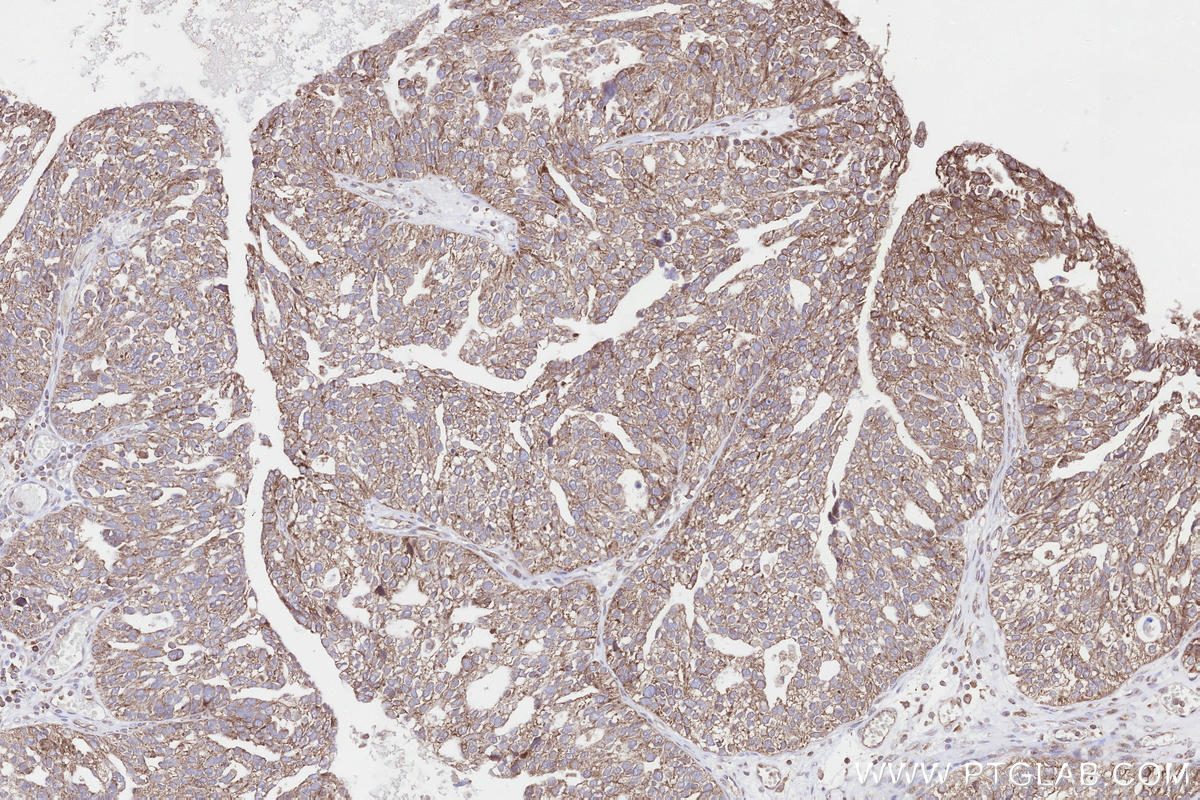Immunohistochemical analysis of paraffin-embedded human ovary cancer tissue slide using KHC3285 (NDUFA11 IHC Kit).