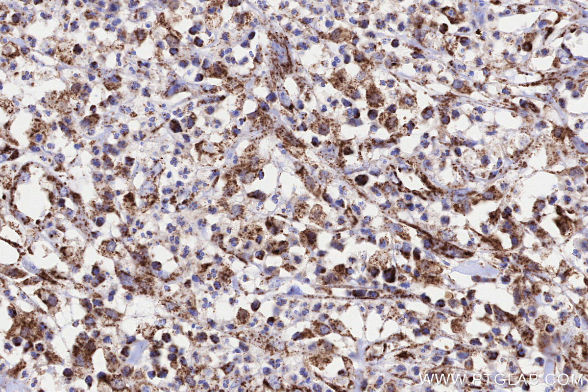 Immunohistochemical analysis of paraffin-embedded human colon cancer tissue slide using KHC3225 (NDUFA8 IHC Kit).