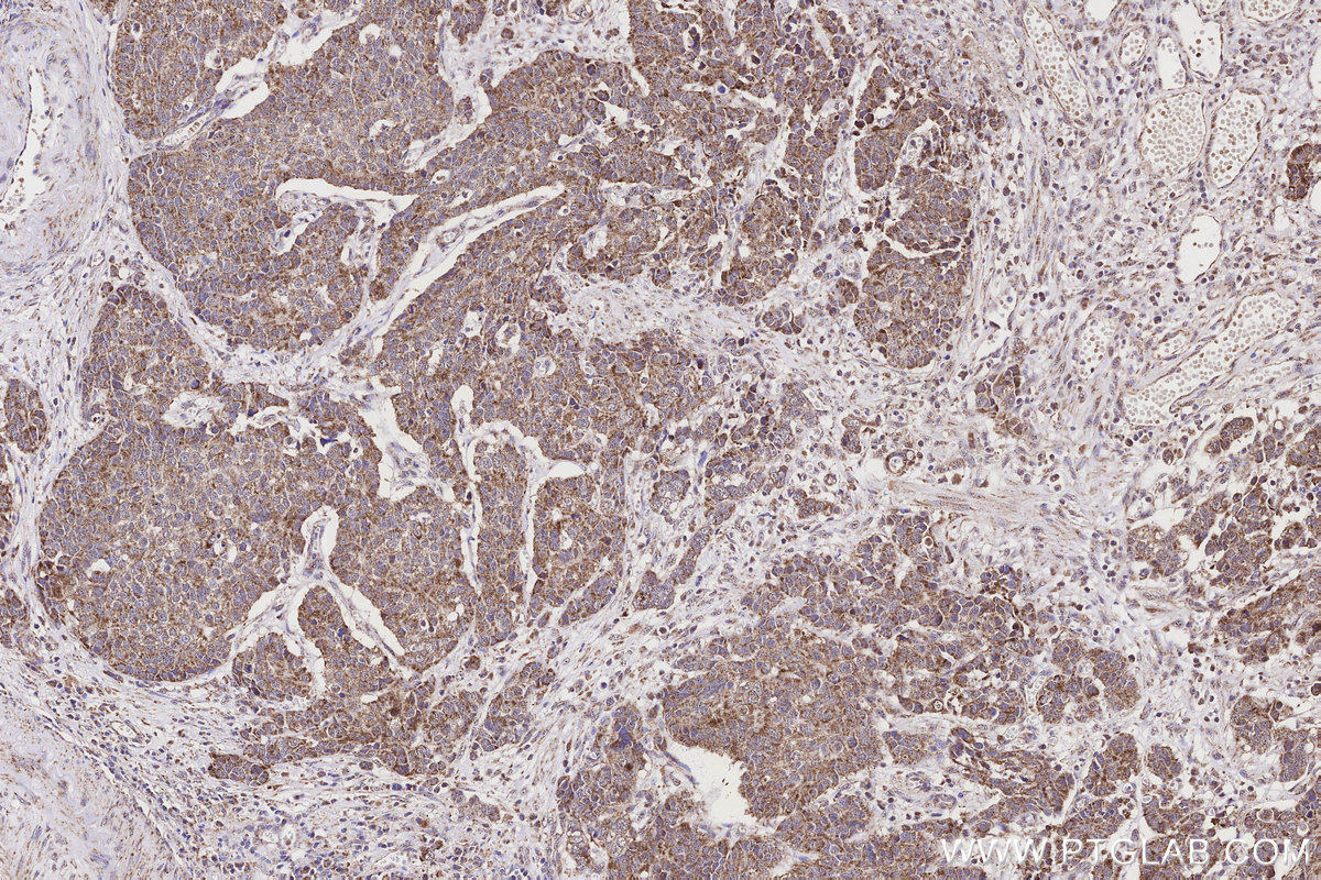 Immunohistochemical analysis of paraffin-embedded human stomach cancer tissue slide using KHC3158 (NDUFB10 IHC Kit).