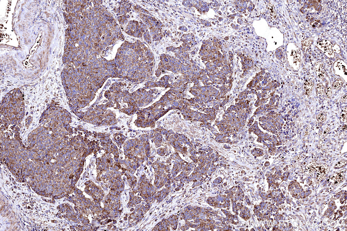 Immunohistochemical analysis of paraffin-embedded human stomach cancer tissue slide using KHC3153 (NDUFB4 IHC Kit).