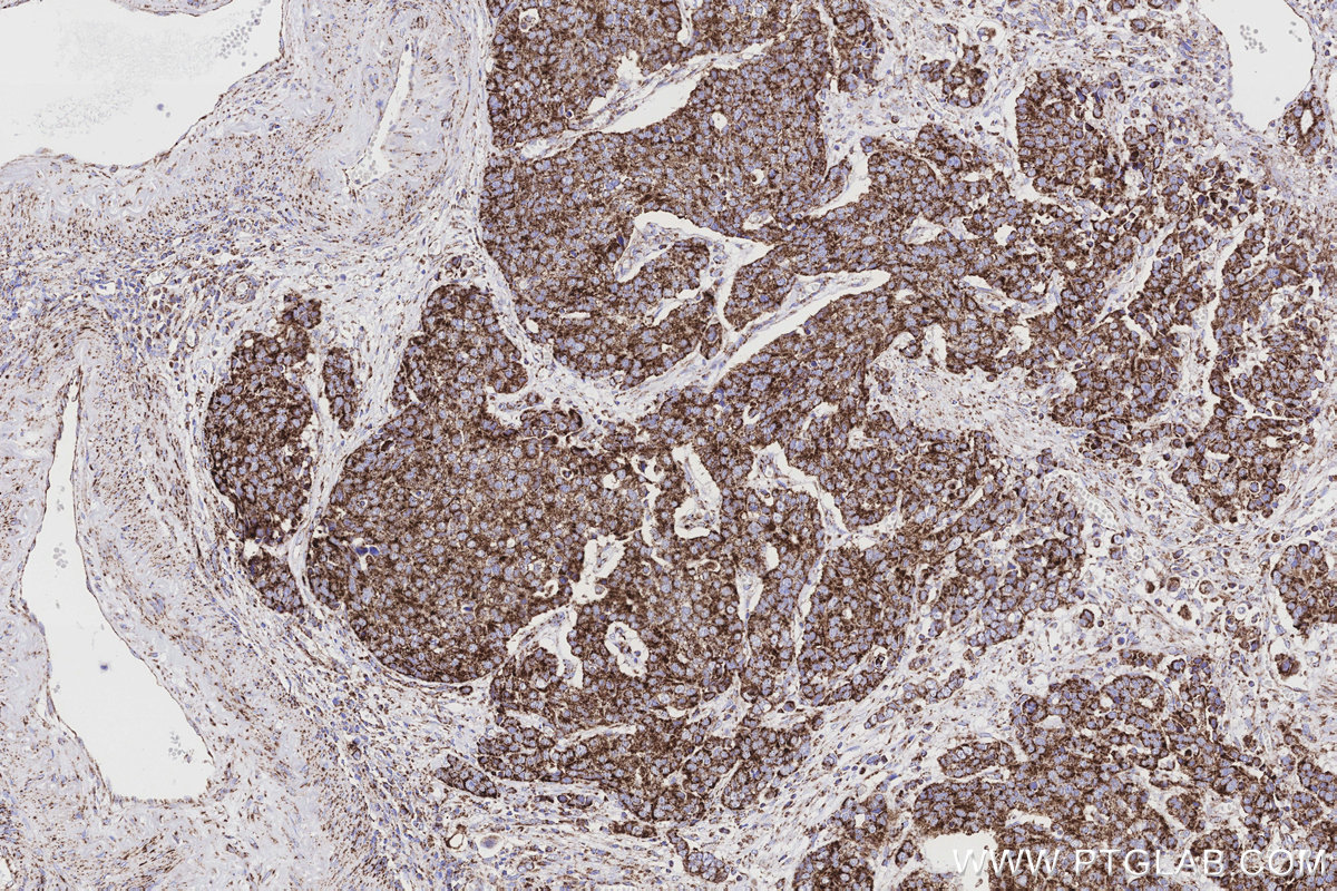 Immunohistochemical analysis of paraffin-embedded human stomach cancer tissue slide using KHC3193 (NDUFB7 IHC Kit).