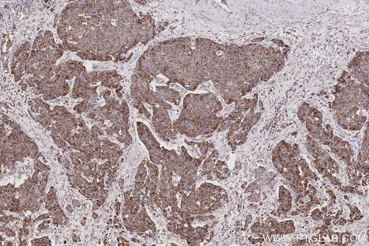 Immunohistochemical analysis of paraffin-embedded human stomach cancer tissue slide using KHC3149 (NDUFS2 IHC Kit).