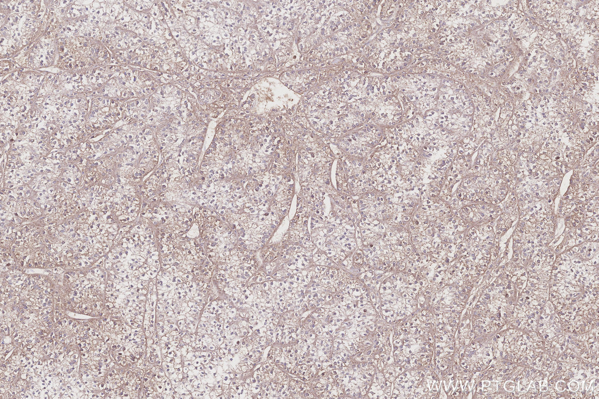 Immunohistochemical analysis of paraffin-embedded human renal cell carcinoma tissue slide using KHC3178 (NDUFS7 IHC Kit). Immunohistochemical analysis of paraffin-embedded human renal cell carcinoma tissue slide using KHC3178 (NDUFS7 IHC Kit).