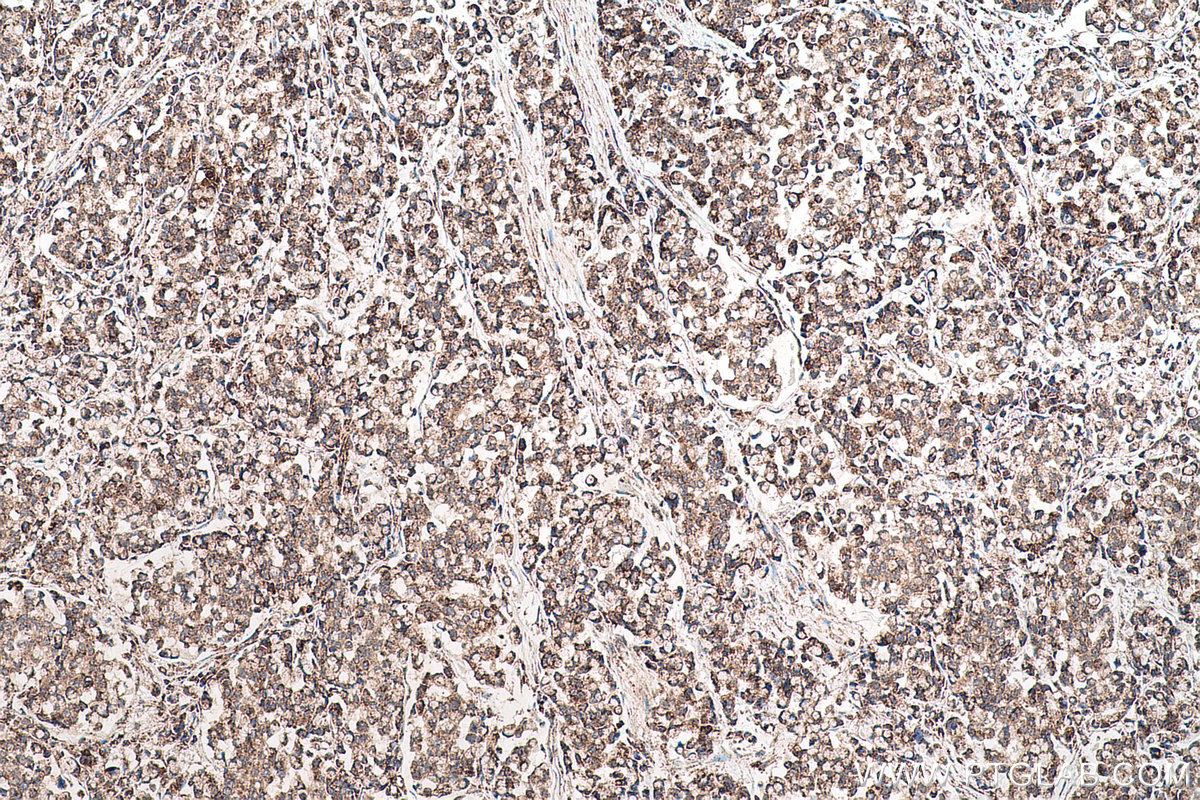 Immunohistochemical analysis of paraffin-embedded human colon cancer tissue slide using KHC0633 (NDUFV1 IHC Kit).