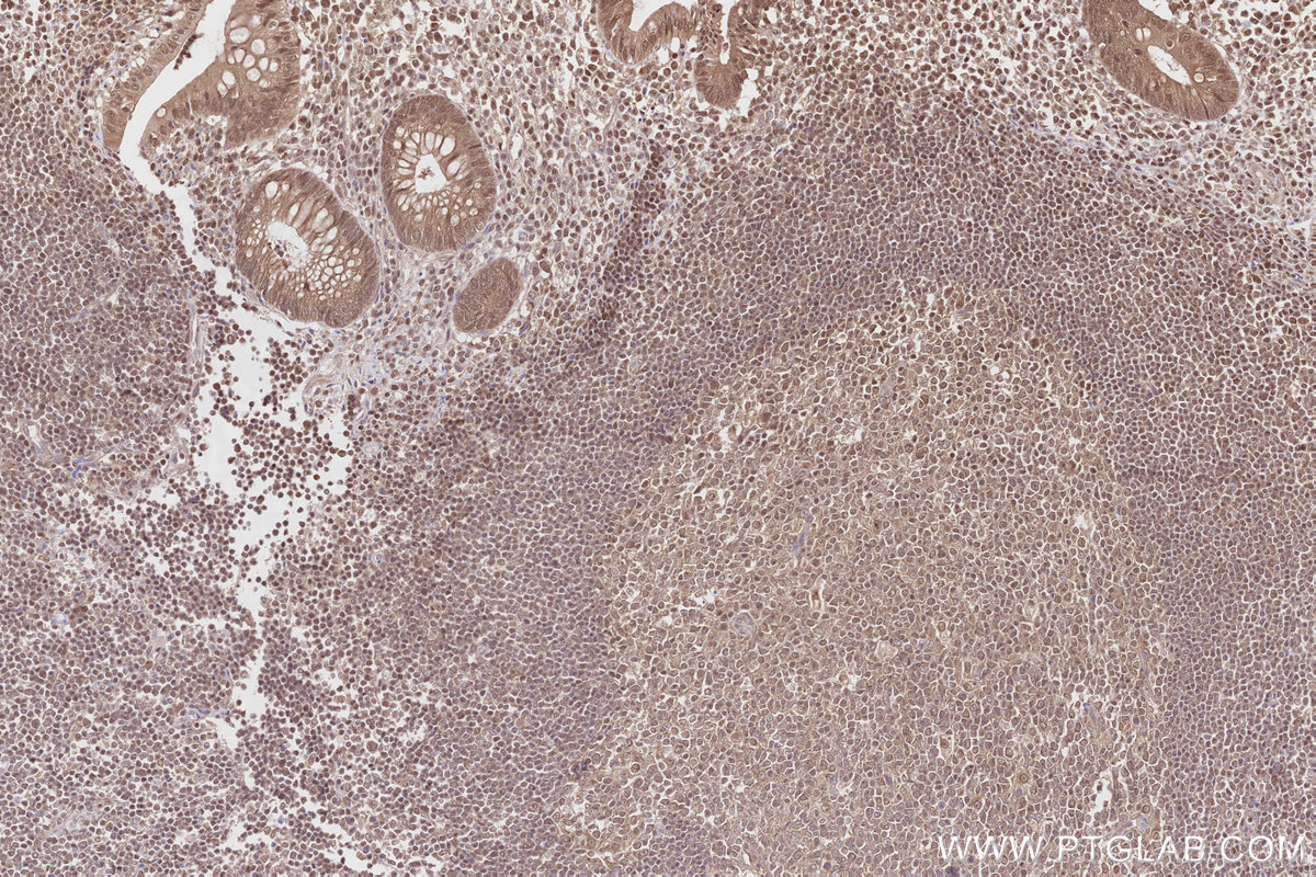 Immunohistochemical analysis of paraffin-embedded human appendicitis tissue slide using KHC2817 (NEK1 IHC Kit).