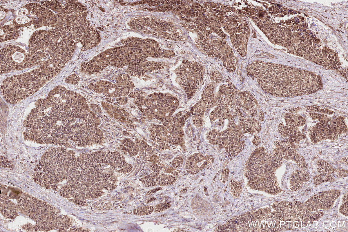 Immunohistochemical analysis of paraffin-embedded human stomach cancer tissue slide using KHC2817 (NEK1 IHC Kit).