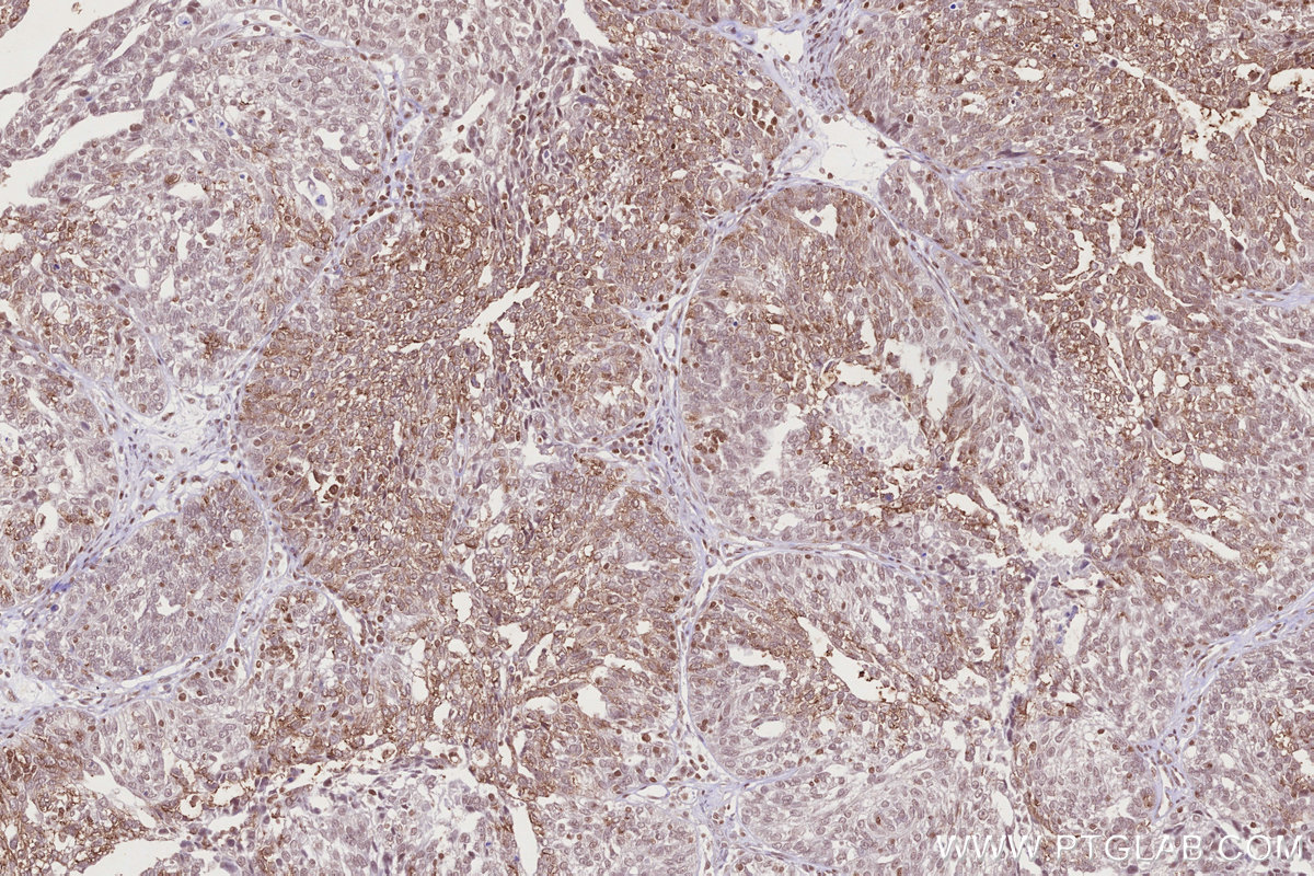 Immunohistochemical analysis of paraffin-embedded human ovary cancer tissue slide using KHC2720 (NEK7 IHC Kit).