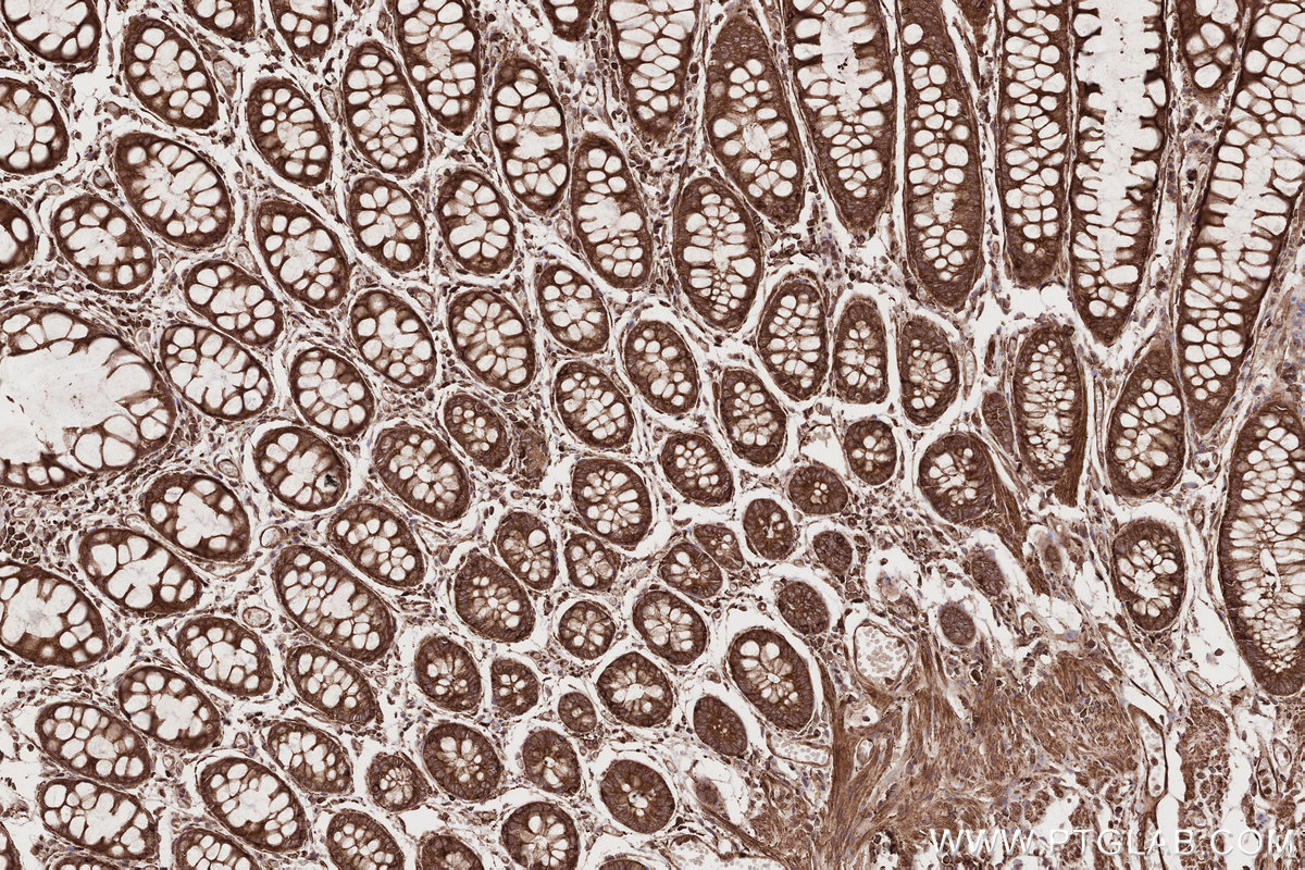 Immunohistochemical analysis of paraffin-embedded human rectal cancer tissue slide using KHC2716 (NEK9 IHC Kit).