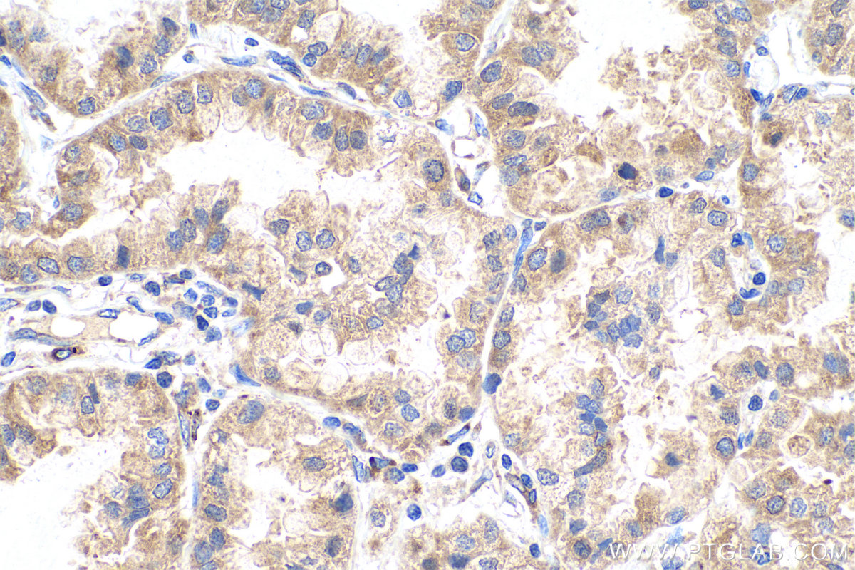 Immunohistochemical analysis of paraffin-embedded human lung cancer tissue slide using KHC0897 (NENF IHC Kit).