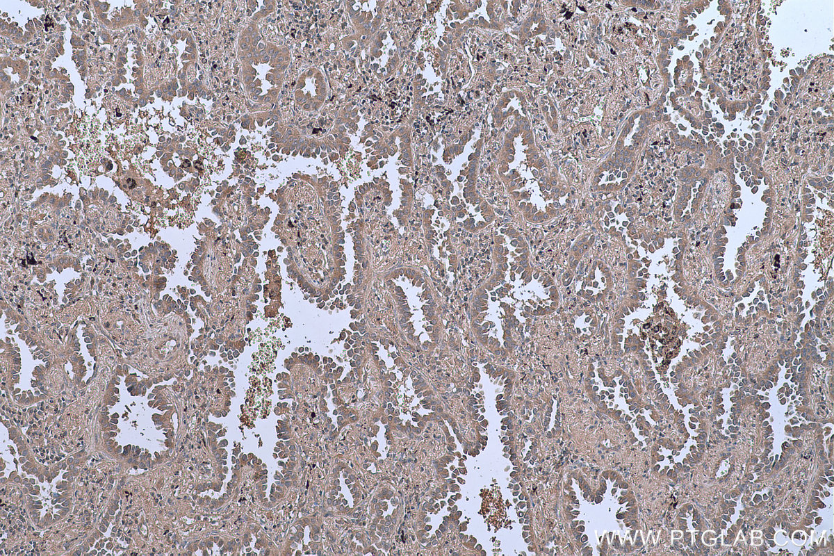 Immunohistochemical analysis of paraffin-embedded human lung cancer tissue slide using KHC0634 (NF-κB p65 IHC Kit).