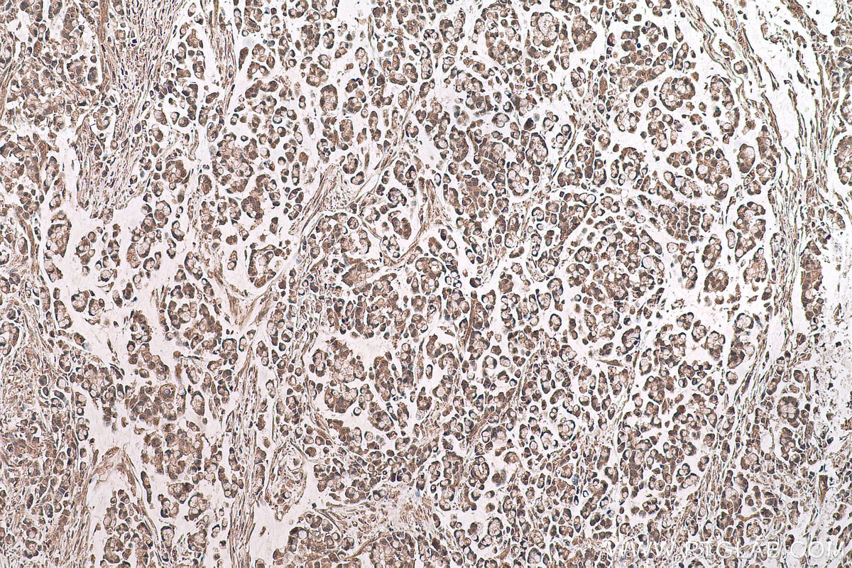 Immunohistochemical analysis of paraffin-embedded human colon cancer tissue slide using KHC0634 (NF-κB p65 IHC Kit).