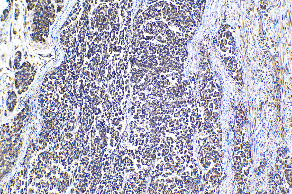 Immunohistochemical analysis of paraffin-embedded human colon cancer tissue slide using KHC1057 (NF1 IHC Kit).