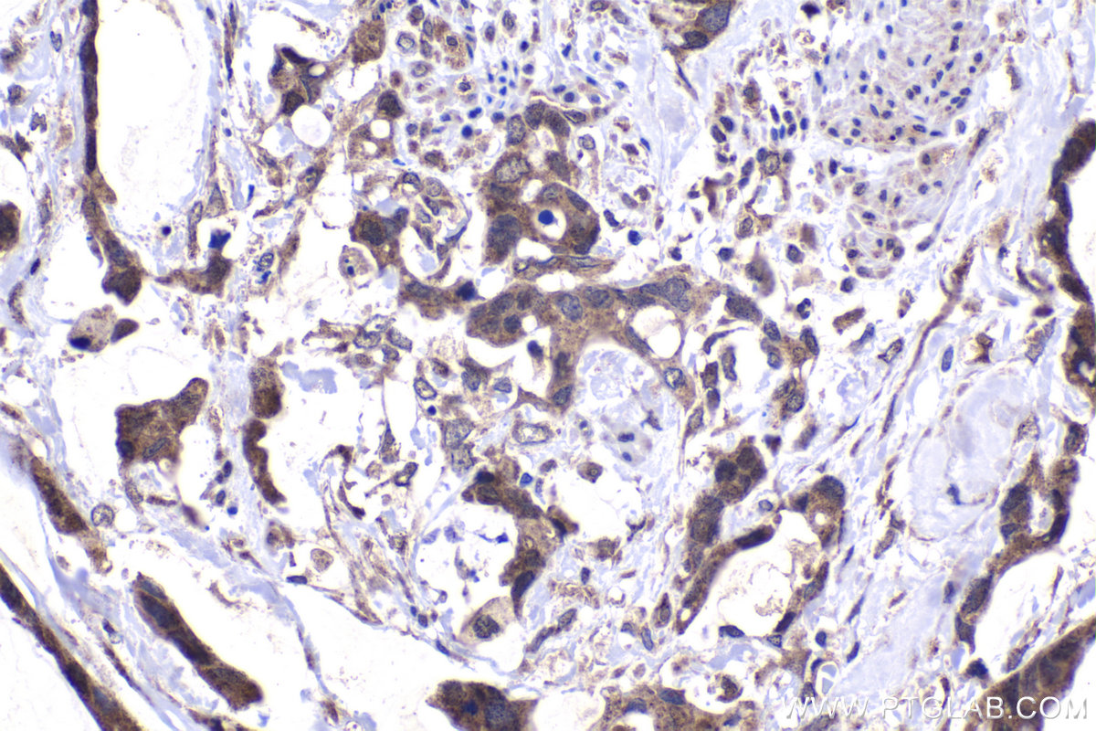 Immunohistochemical analysis of paraffin-embedded human urothelial carcinoma tissue slide using KHC1488 (NFAT5 IHC Kit).