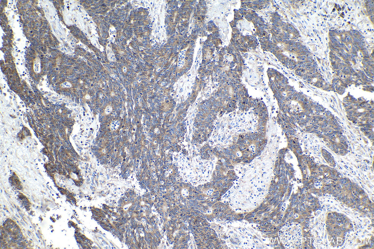 Immunohistochemical analysis of paraffin-embedded human colon cancer tissue slide using KHC1065 (NFE2L2/NRF2 IHC Kit).