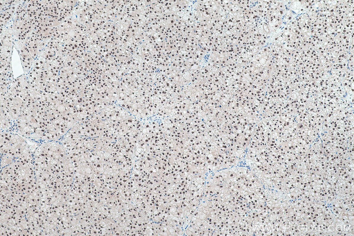 Immunohistochemical analysis of paraffin-embedded human liver cancer tissue slide using KHC0441 (NFIC IHC Kit).