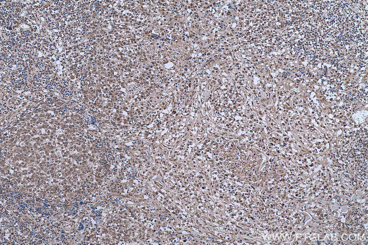 Immunohistochemical analysis of paraffin-embedded human lymphoma tissue slide using KHC0635 (NFKB1 IHC Kit).