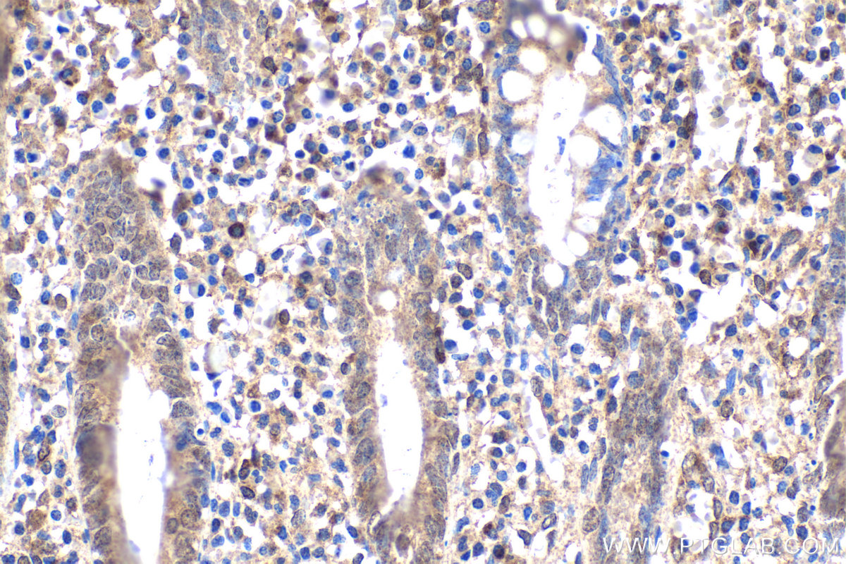 Immunohistochemical analysis of paraffin-embedded human appendicitis tissue slide using KHC1659 (NFKB2 IHC Kit).