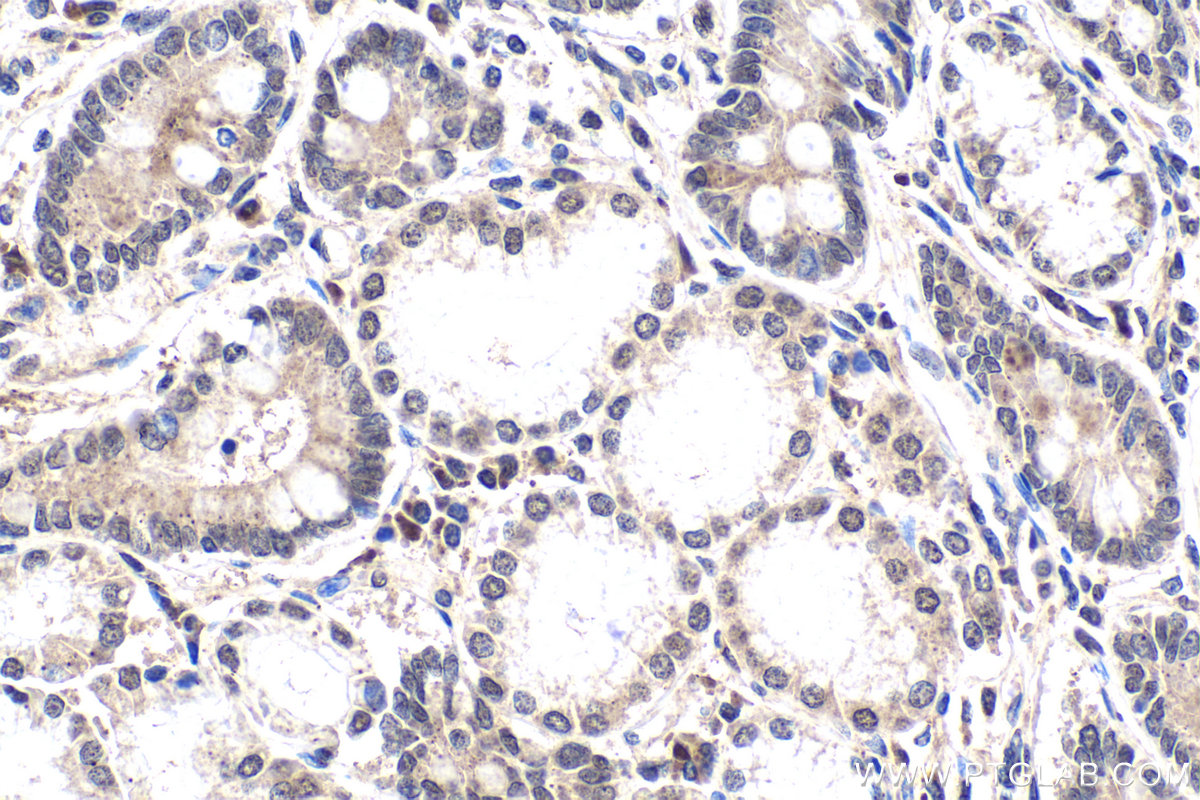 Immunohistochemical analysis of paraffin-embedded human stomach cancer tissue slide using KHC1659 (NFKB2 IHC Kit).