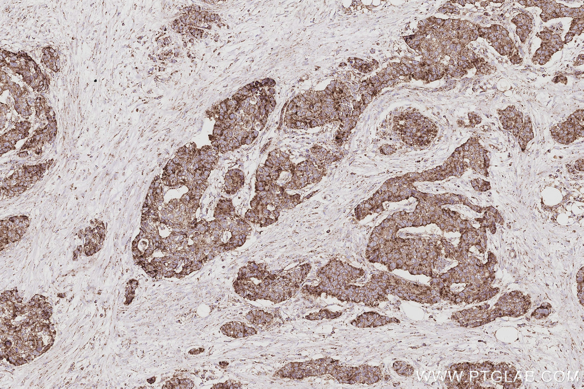 Immunohistochemical analysis of paraffin-embedded human stomach cancer tissue slide using KHC3085 (NFS1 IHC Kit). Immunohistochemical analysis of paraffin-embedded human stomach cancer tissue slide using KHC3085 (NFS1 IHC Kit).