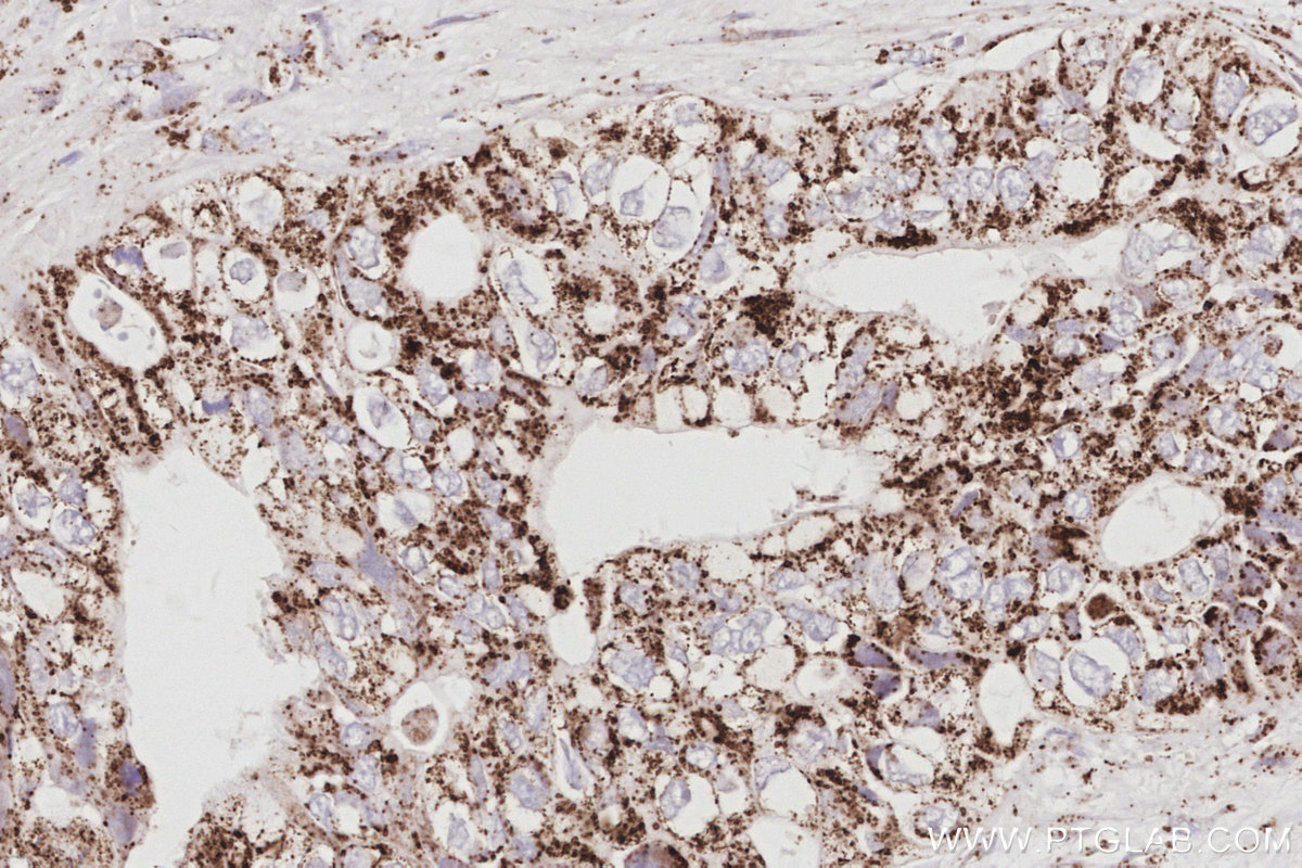 Immunohistochemical analysis of paraffin-embedded human pancreas cancer tissue slide using KHC3085 (NFS1 IHC Kit). Immunohistochemical analysis of paraffin-embedded human pancreas cancer tissue slide using KHC3085 (NFS1 IHC Kit).
