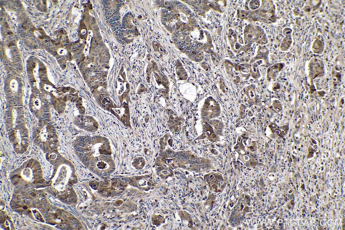 Immunohistochemical analysis of paraffin-embedded human colon cancer tissue slide using KHC0307 (NGAL/LCN2 IHC Kit).