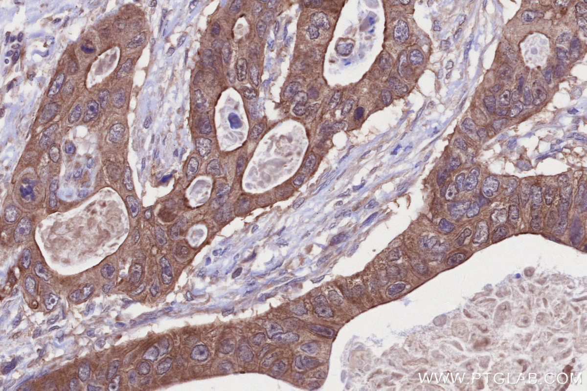 Immunohistochemical analysis of paraffin-embedded human stomach cancer tissue slide using KHC2678 (NGEF IHC Kit).