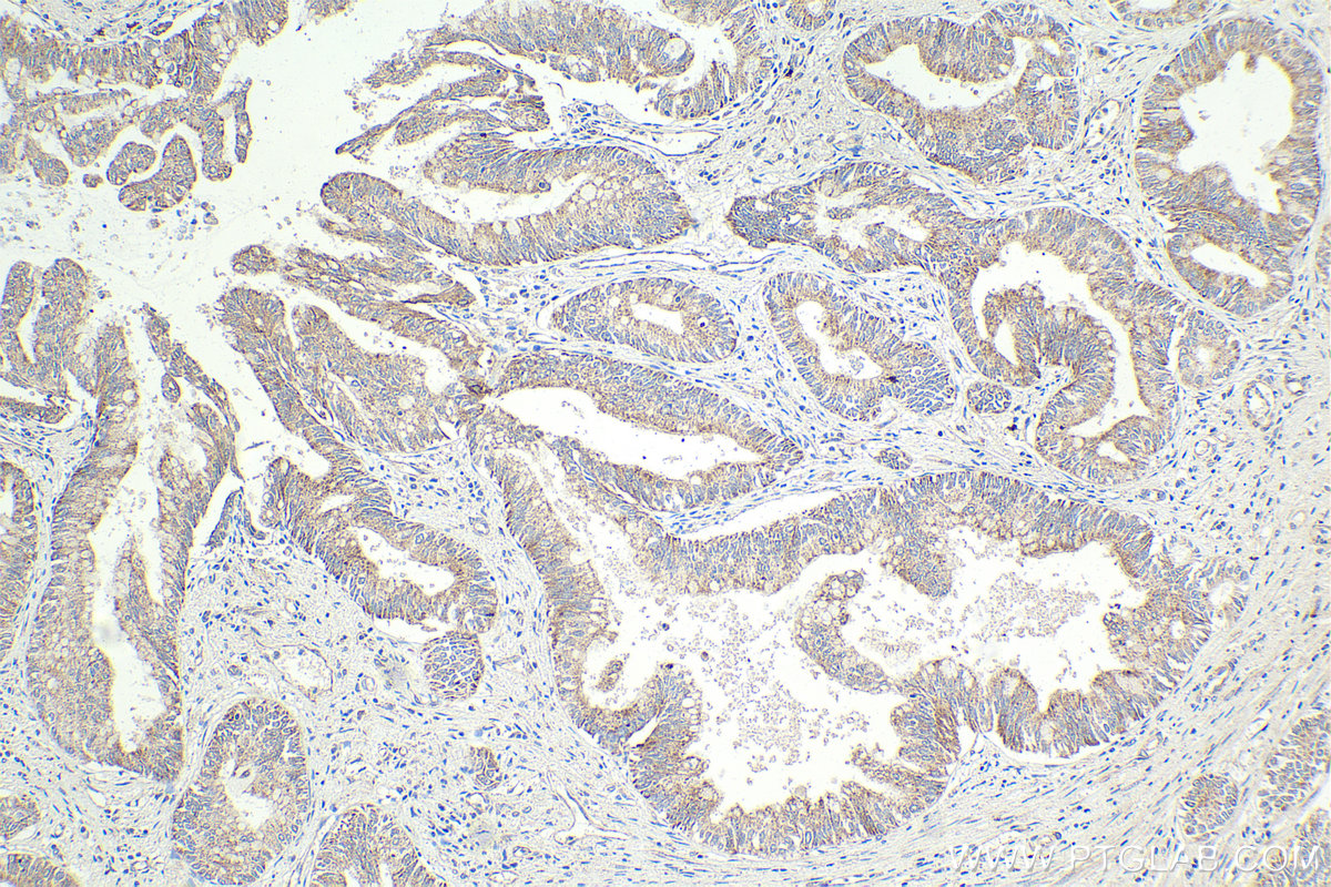 Immunohistochemical analysis of paraffin-embedded human pancreas cancer tissue slide using KHC1913 (NLRP1 IHC Kit).