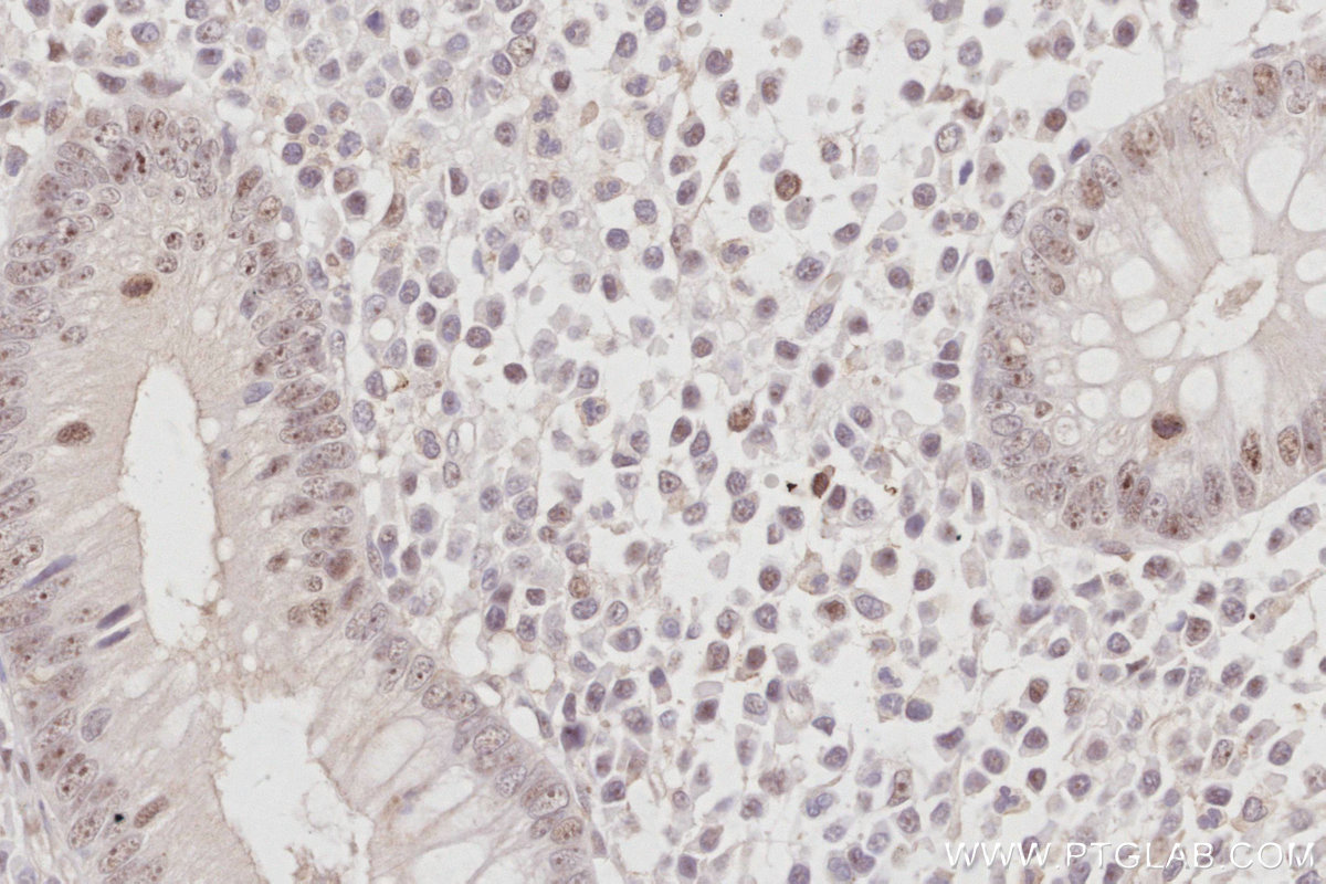Immunohistochemical analysis of paraffin-embedded human appendicitis tissue slide using KHC3067 (NOC2L IHC Kit). Immunohistochemical analysis of paraffin-embedded human appendicitis tissue slide using KHC3067 (NOC2L IHC Kit).