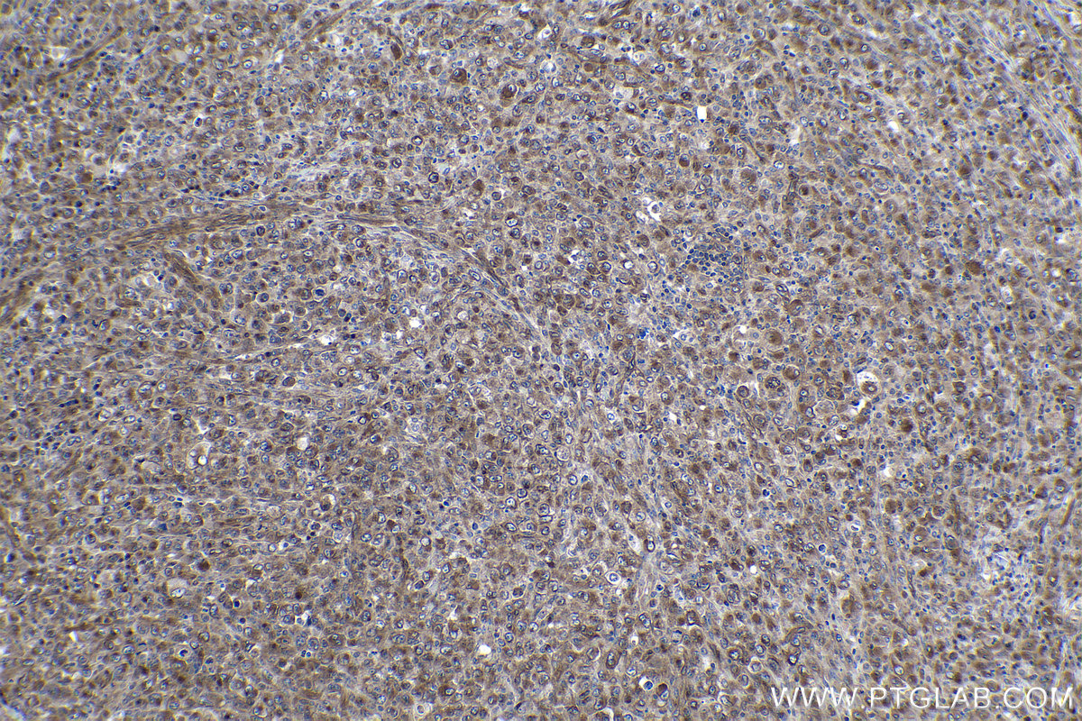 Immunohistochemical analysis of paraffin-embedded human lymphoma tissue slide using KHC1061 (NOTCH1 IHC Kit).