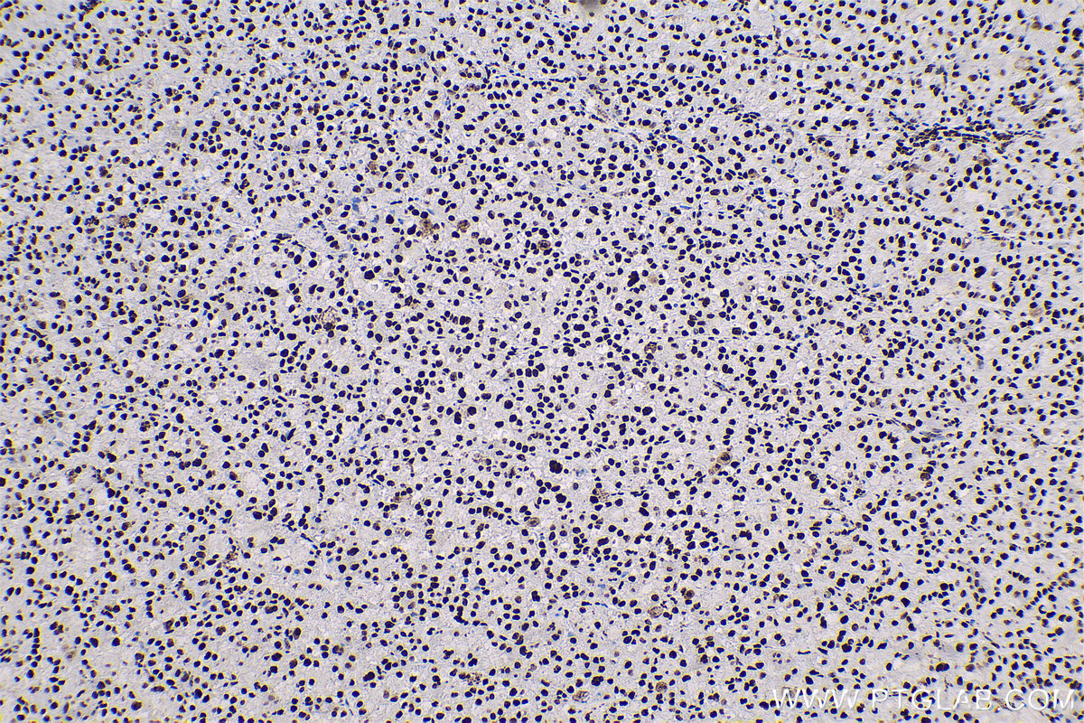 Immunohistochemical analysis of paraffin-embedded human liver cancer tissue slide using KHC0621 (B23/NPM1 IHC Kit).