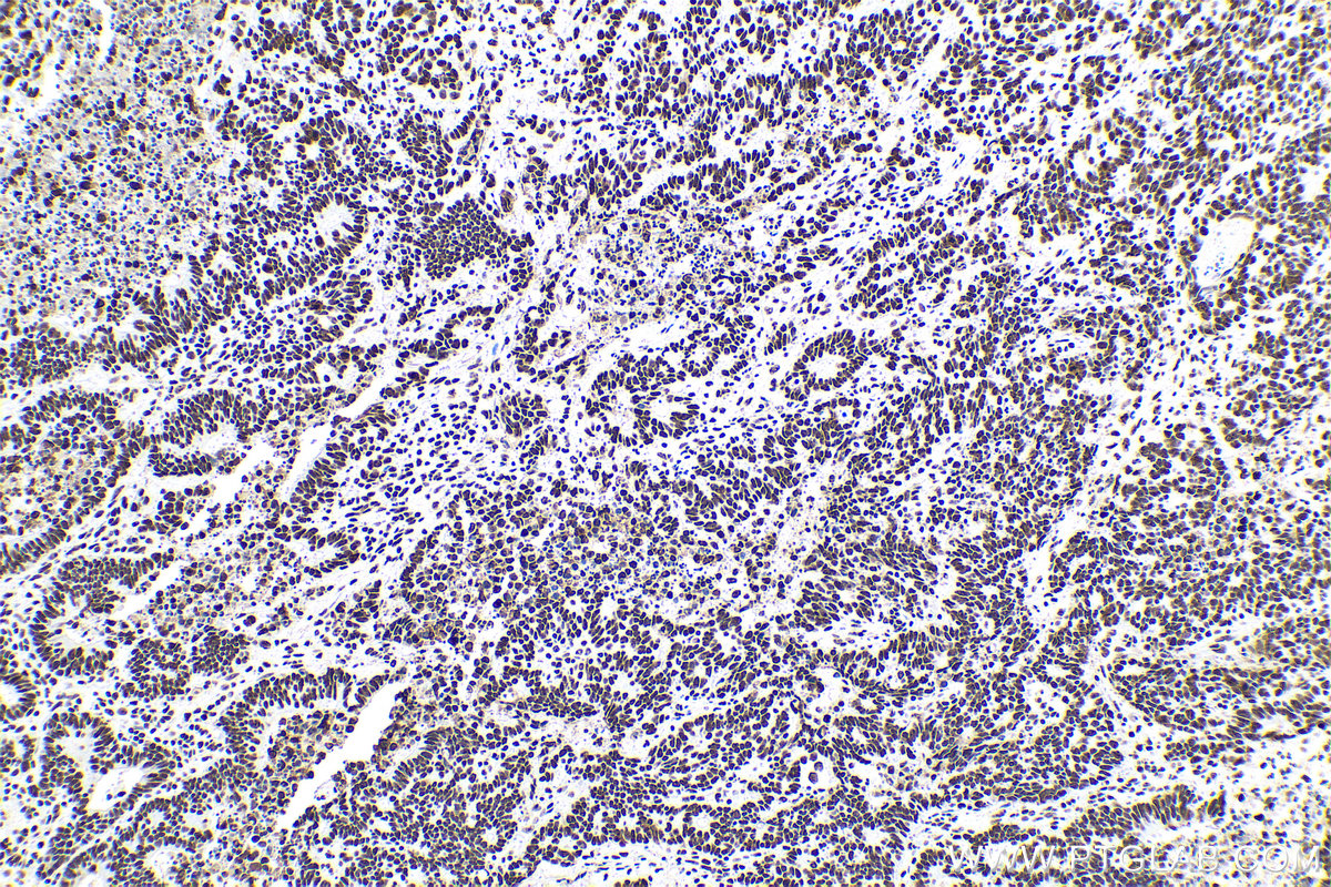 Immunohistochemical analysis of paraffin-embedded human colon cancer tissue slide using KHC0621 (B23/NPM1 IHC Kit).